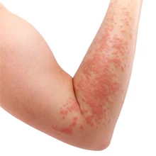Atopiás dermatitis, ekcéma