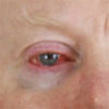 Allergiás szemtünetek