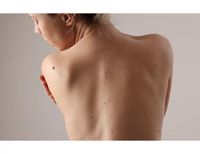 Anyajegy vagy bőrrák?  Az anyajegyekről
