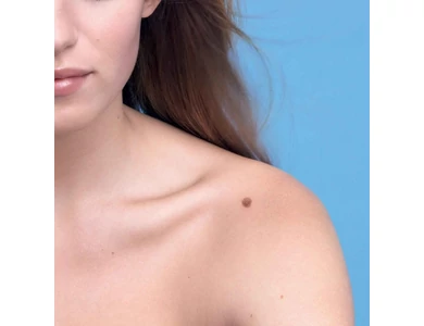 Mikor szükséges az anyajegy eltávolítás?