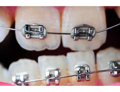 Nem megfelelő szájápolás mellett akár meg is duplázódhat a fogszabályozás ideje