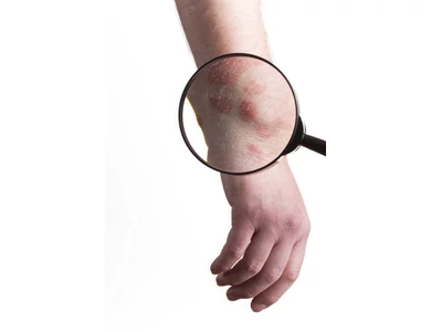 Ekcéma: új terápiás lehetőség