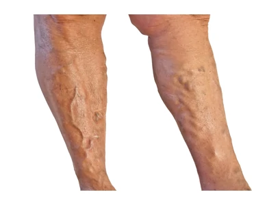 Ragasztásos visszérműtét