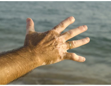 Vitiligo - Te mit tudsz róla?