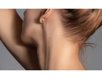 Ne adjon esélyt a hegek kialakulásának!