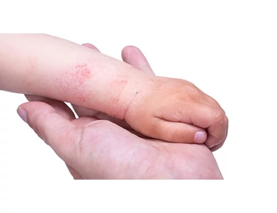 Ekcéma - Mi okozhatja, és hogyan kezeljük?