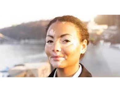 Vitiligo - Egy titokzatos bőrbetegség
