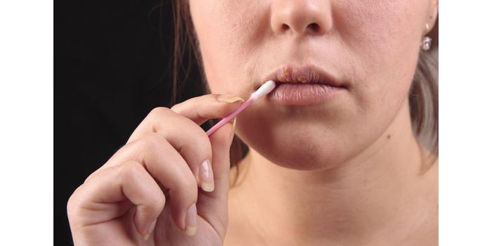 Az ajakherpesz mindig kísért - Megelőzés és kezelés