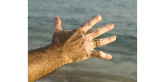 Vitiligo - Te mit tudsz róla?